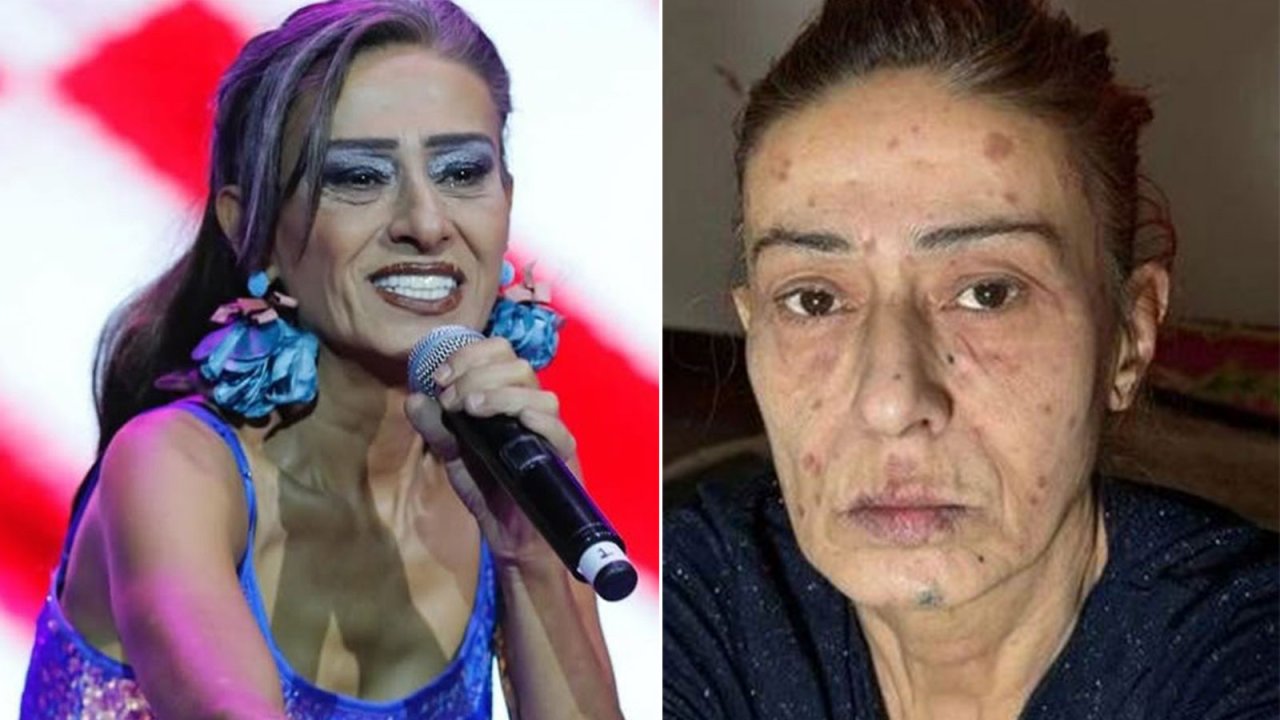 Yıldız Tilbe, yüzündeki yanıklarla ilgili son durumu açıkladı! 3 504913