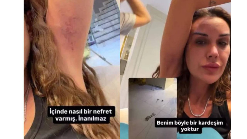 Dilan Polat’tan şok iddia! “Ablam tarafından darbedildim” diyerek izleri paylaştı 3 553066